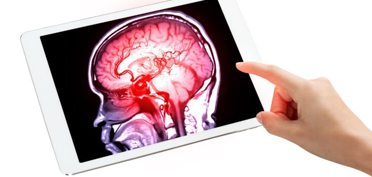 Vaskuläre Demenz: Eine unterschätzte Gefahr